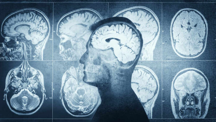 Human,Head,On,Ct,Scan,With,Brain,Background.,Overlay,On