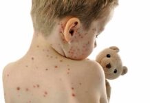 Child with red spots on back holding a teddy bear